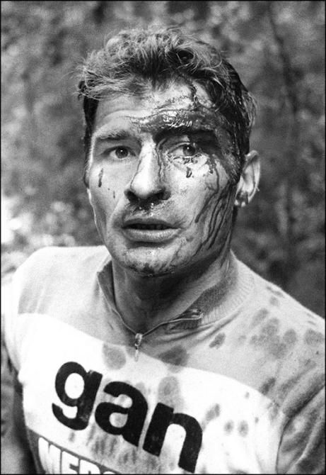 Raymond Poulidor shows the wounds from a crash on the descent of the Porte d'Aspet after stage 13 of the 1973 Tour de France.