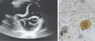 A man's ultrasound (left) showed tubular structures "that moved with a curling motion," which were later identified as the roundworm Ascaris lumbricoides, according to a new report. The man's stool was found to contain eggs from the worm (right).