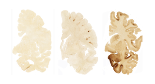 This image of a brain hemisphere shows, from left to right, the difference between a normal brain, the brain of someone with mild CTE, and the brain of someone with severe CTE.