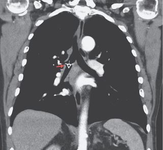 An image of a chicken vertebra bone in a man's lung. The bone, highlighted with a red arrow, is in the bronchus," the airway passage that branches off from the trachea into the lung.