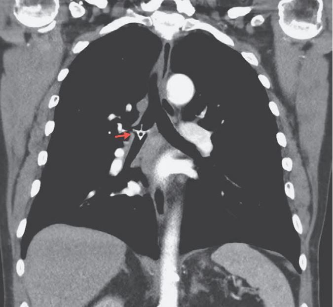 An image of a chicken vertebra bone in a man&#039;s lung. The bone, highlighted with a red arrow, is in the bronchus,&quot; the airway passage that branches off from the trachea into the lung.