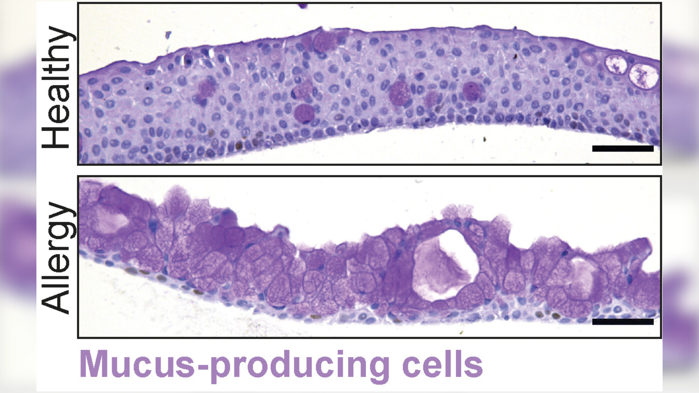 Microscope image comparing the conjunctiva organoid before the induction of allergy-like conditions (at the top) and after (at the bottom). There is an increase in the amount of mucus-producing cells in purple at the bottom
