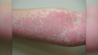 close up image of a white person's arm covered in red hives