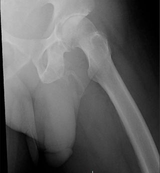 An X-ray showing "plaque-like calcification" in the expected area of the penis.