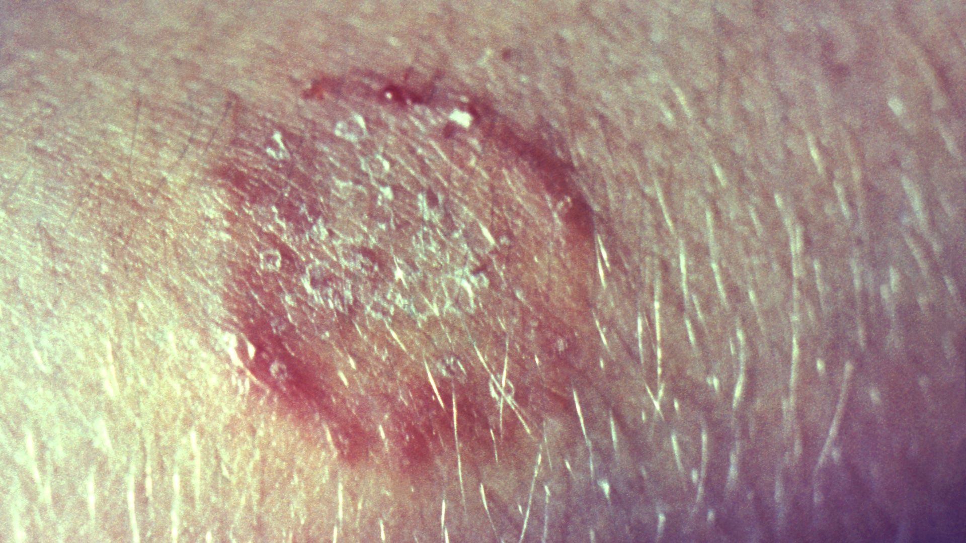Close up of a ring-shaped sore on human skin