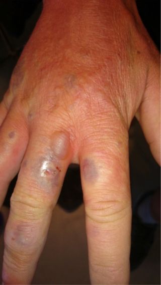 The inflamed, purple-colored blisters on the man's right hand, just before the doctors lanced them.