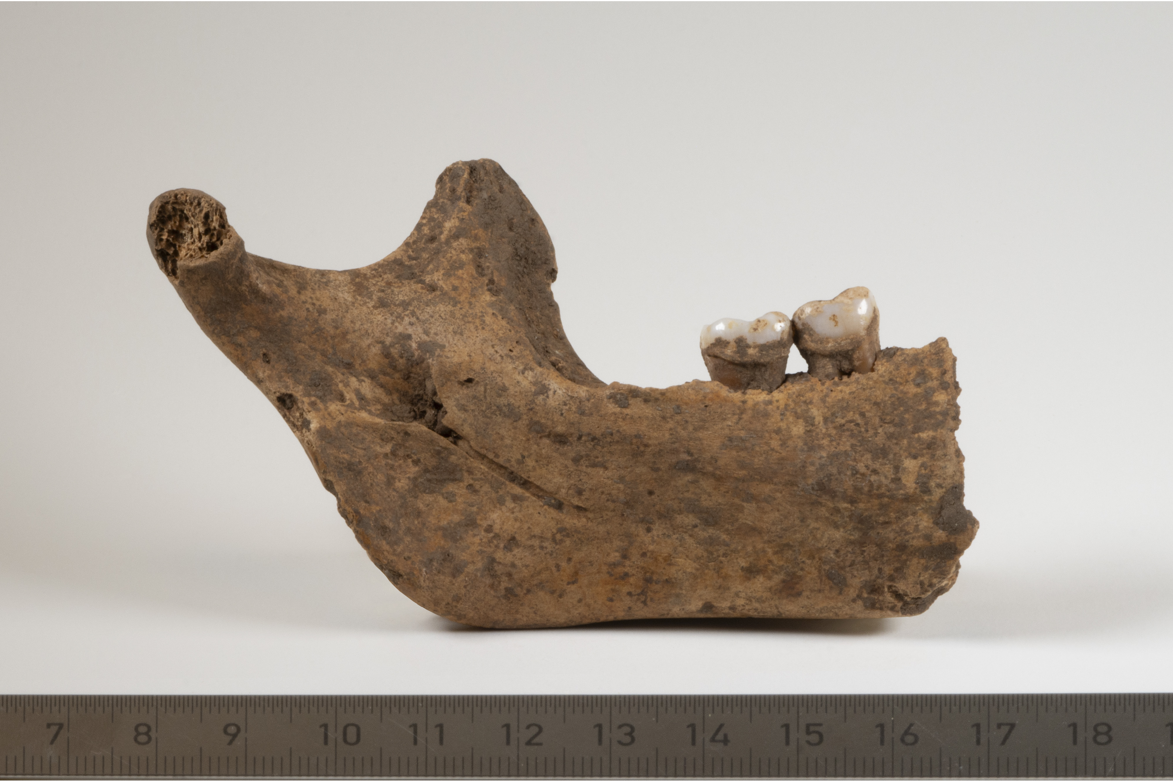 A human jaw bone with two teeth intact