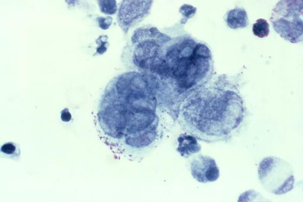 herpes simplex virus