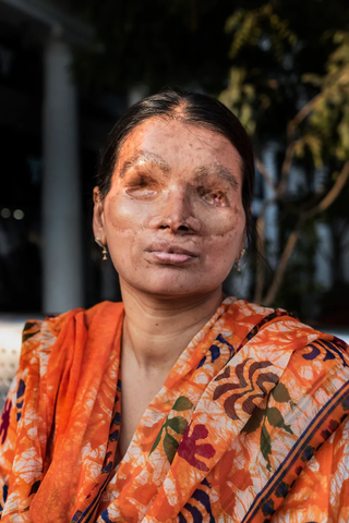 Anumukherjee was blinded and scarred in an acid attack by one of her female friends, who was jealous of her beauty