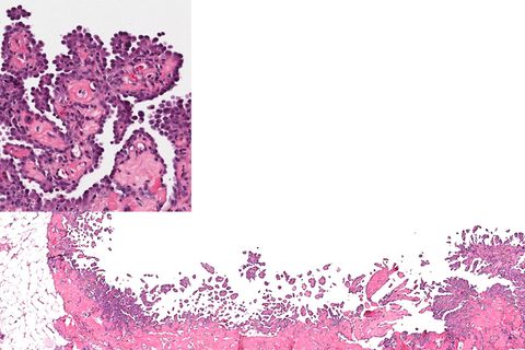 Malignant Mesothelioma: Symptoms and Treatments | Live Science