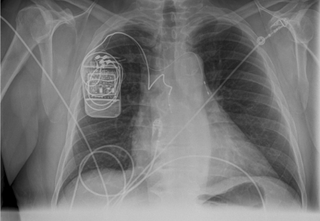 The device is shown in an x-ray of a person's chest.