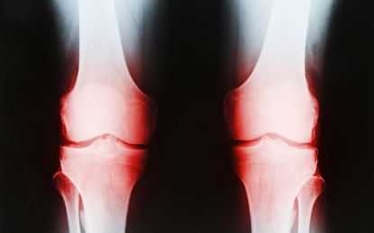 Get a (Planned) Knee Replacement by Year-End