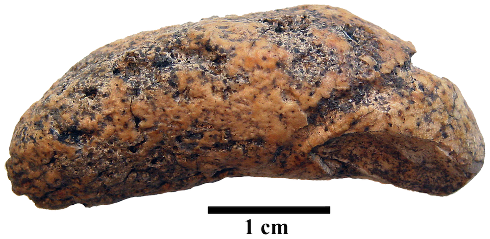 bladder stone