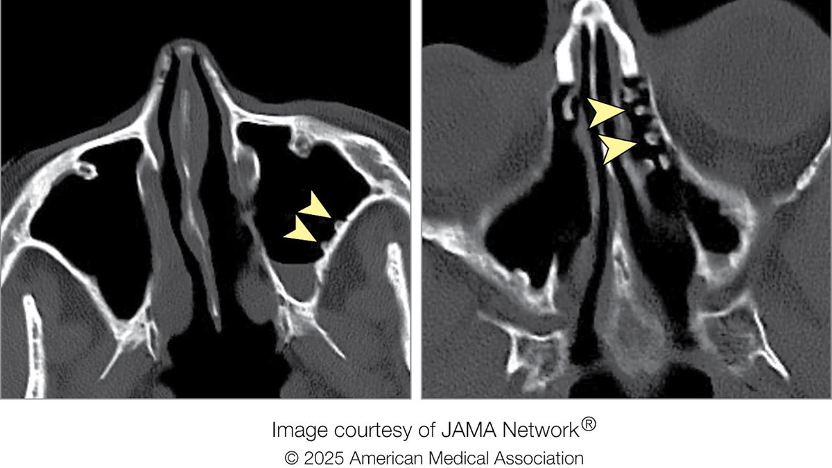 Diagnostic dilemma: Cold-water rinses left 'cobblestone' growths in woman's sinuses