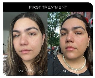Before and after photos of woman getting lip filler dissolver