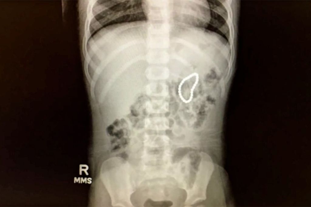 Toddler Swallows 28 Buckyballs Why These Are So Dangerous