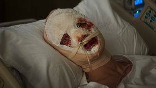 Matt Hagen in hospital bed with bloodied face under bandages and tape in Clayface