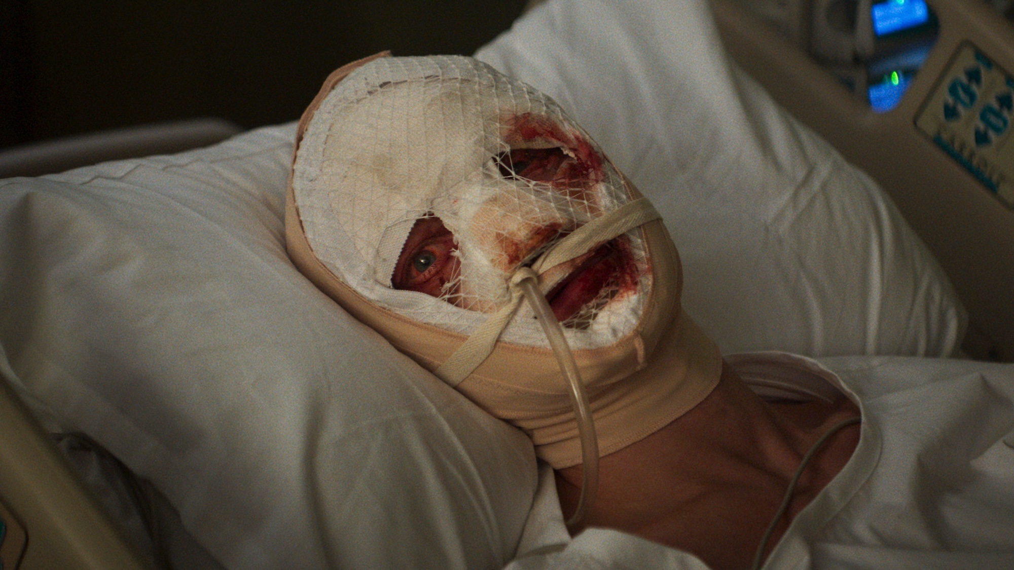 Matt Hagen in hospital bed with bloodied face under bandages and tape in Clayface