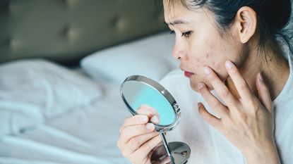Close up of Asian woman worry about her face when she saw the problem of adult acne and scar by the mini mirror. - stock photo