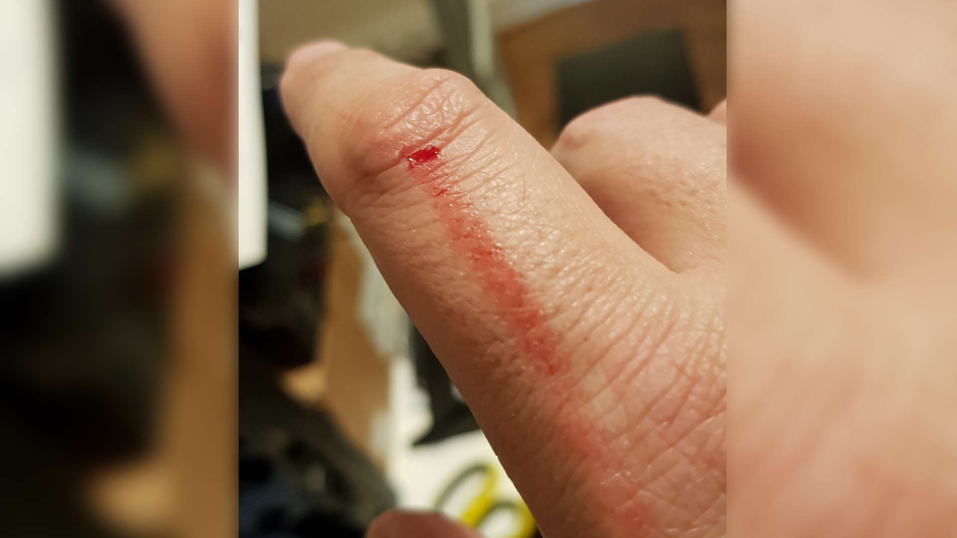 Injury resulting from building the Lian Li desk PC chassis