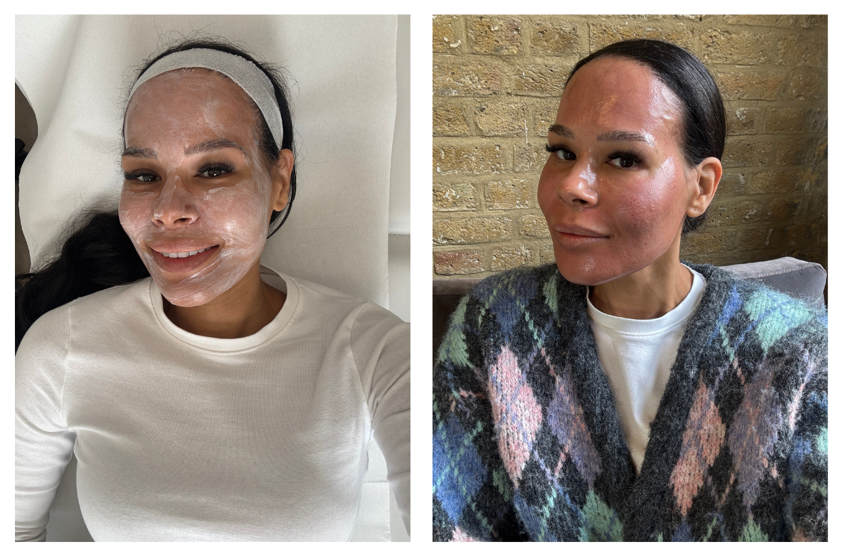 Amerley before and after Moxi Laser