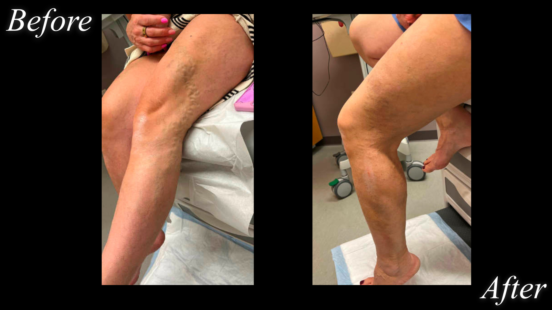 before and after photos of varicose veins treated with left leg phlebectomy