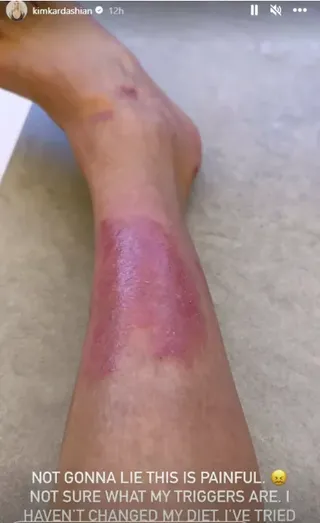 kim kardashian with psoriasis on her legs