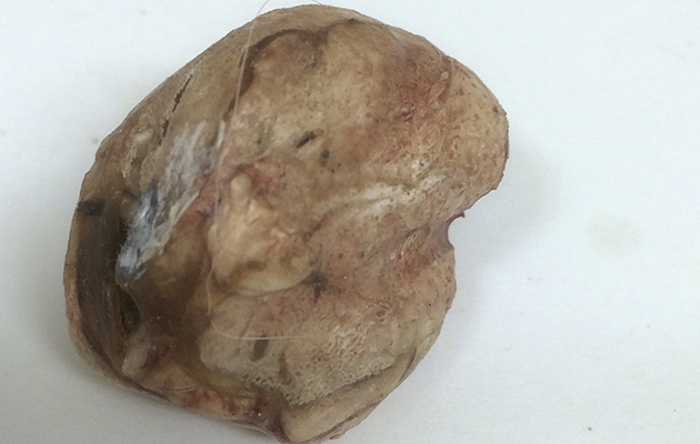 2 teratoma 2