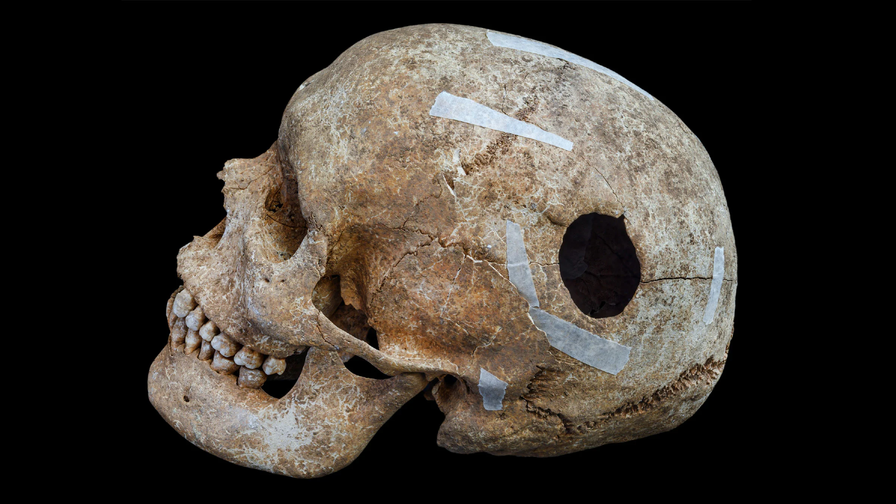 left side view of a human skull with a large oval hole in the parietal bone