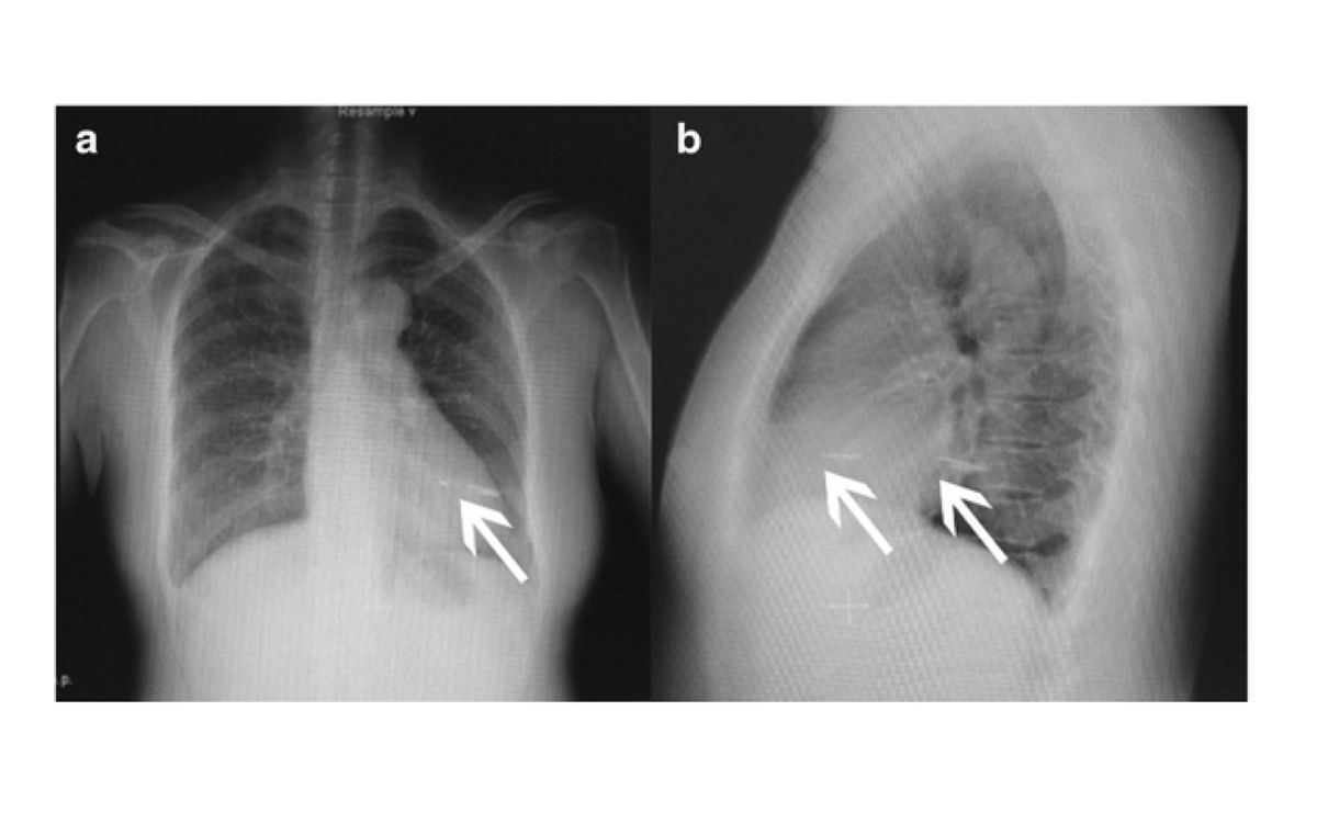 An image of the woman&#039;s chest x-ray highlights the location of the needle.