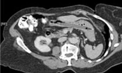 A CT scan of a 76-year-old woman's stomach shows the outline of a pen that was lodged there for 25 years. 