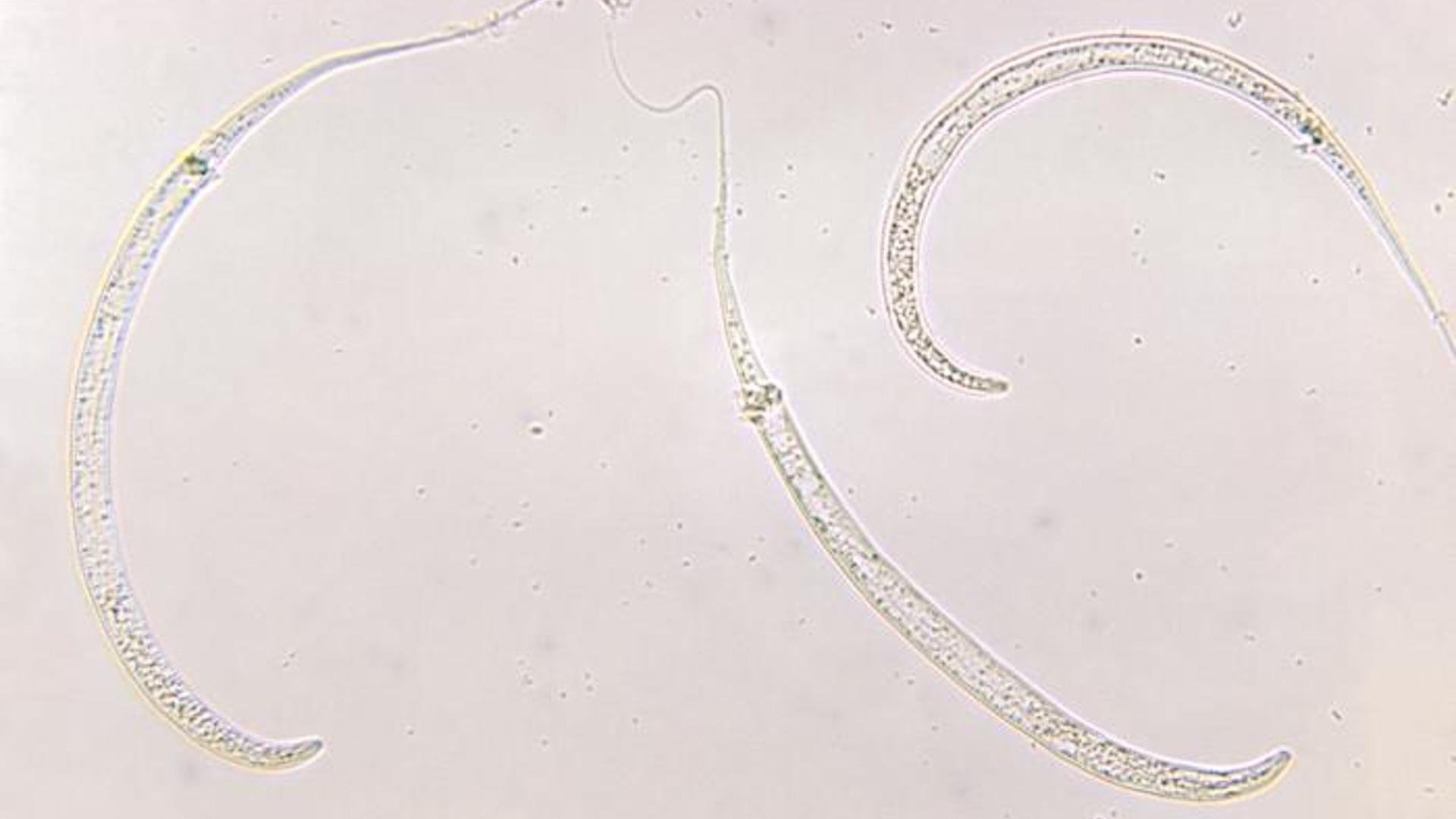 Under a magnification of 125X, this photomicrograph revealed the presence of three Guinea worms, Dracunculiasis medinensis.