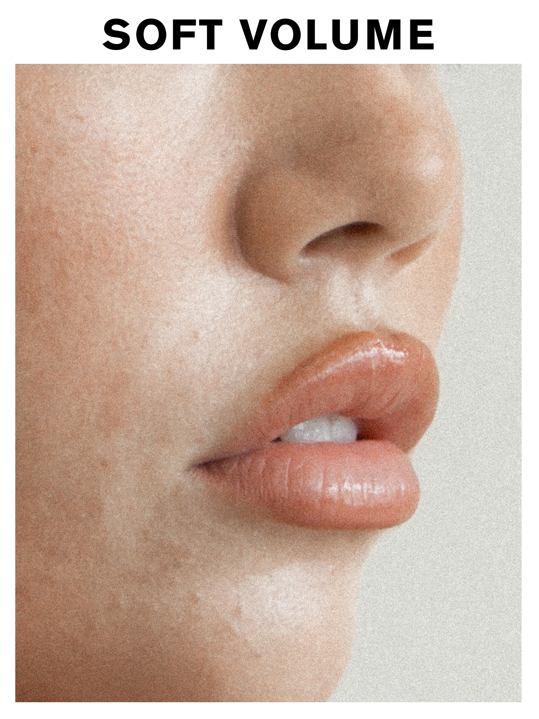 An image of lips with filler, with the copy 