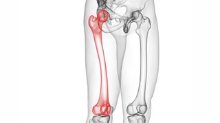 medical illustration shows an x ray view of human legs, with the right femur bone highlighted in red