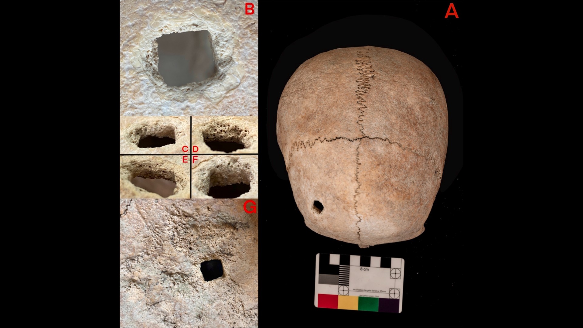 Une femme du IIIe siècle av. J.-C. a été enterrée face contre terre avec un trou de clou dans le crâne.  Voici pourquoi.