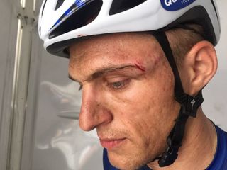 A cut above Marcel Kittel's eye as a result of a punch from Andrey Grivko