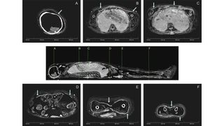CT images show the mummified person from different angles. The carapace can be seen as a thin white line (arrows).