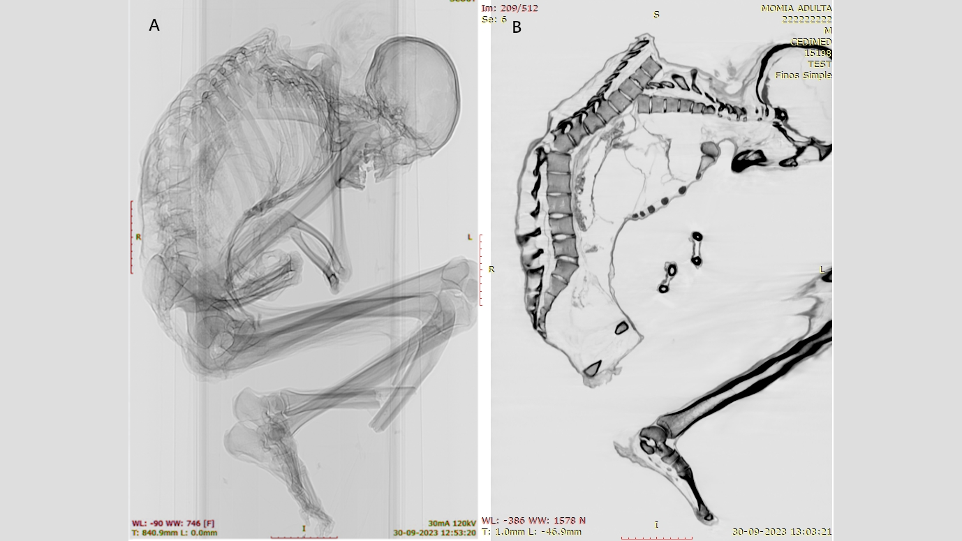 two views of X-rays of a human mummy showing bones