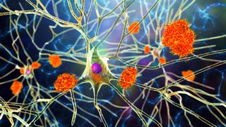 Nerve cells affected by Alzheimer's disease