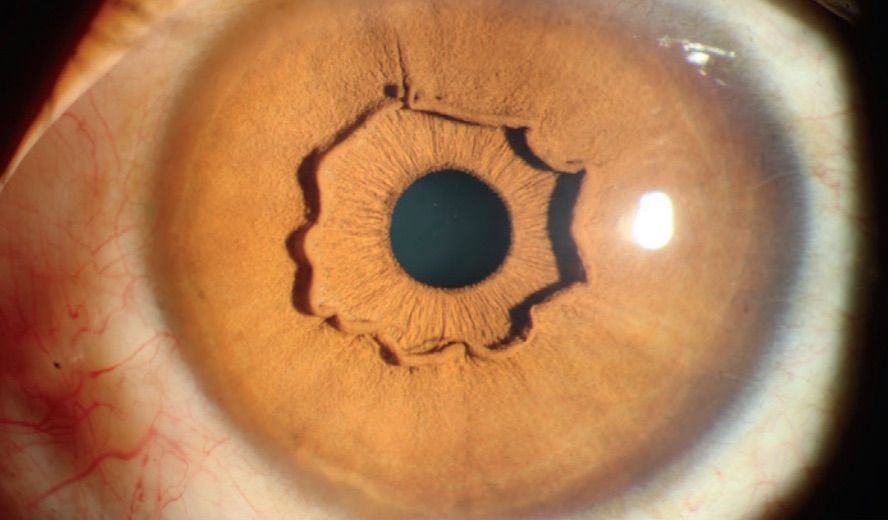 Striking Image Shows 'Protruding' Feature in Woman's Eye Live Science