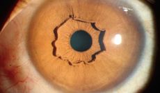 nejm, protruding iris collarette, eye, irisi