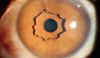 nejm, protruding iris collarette, eye, irisi