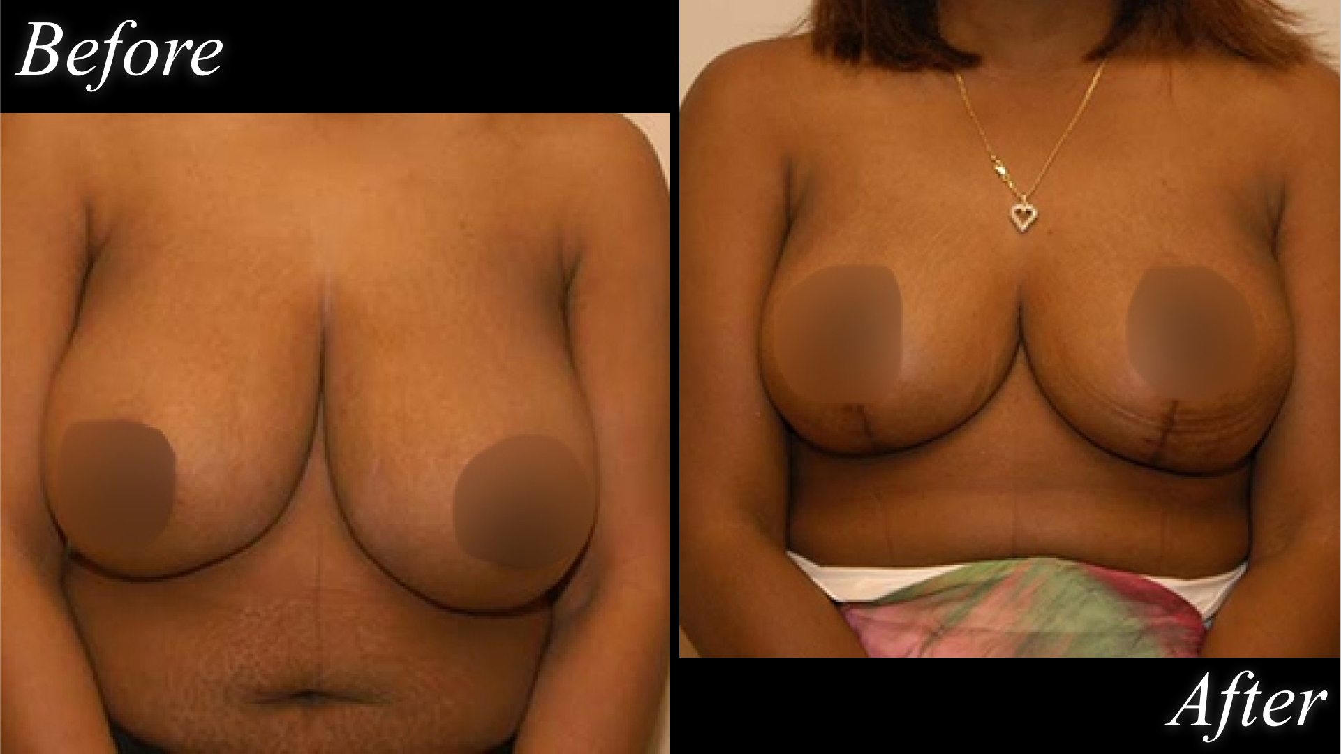 breast reduction before and after picture