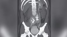 A man in Brazil learned he had three kidneys after receiving a CT scan for low back pain. Above, the CT scan showing the man's three kidneys: A normal-appearing kidney on the man's left side, and two kidneys fused at the pelvis.