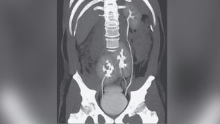 A man in Brazil learned he had three kidneys after receiving a CT scan for low back pain. Above, the CT scan showing the man's three kidneys: A normal-appearing kidney on the man's left side, and two kidneys fused at the pelvis.