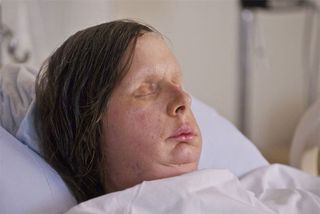 Charla Nash face transplant