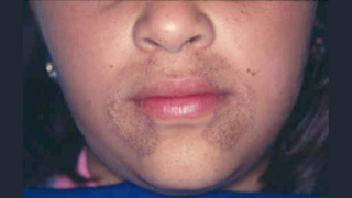 A close-up photo of a patient with alkaptonuria who has dark patches of skin around their mouth.