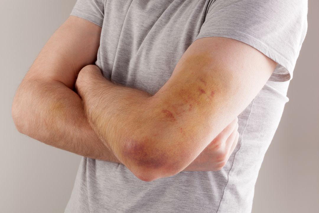 Hemophilia Causes Symptoms Treatment Live Science