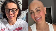 Two pictures of Melanie Sykes showing the extent of her hair loss