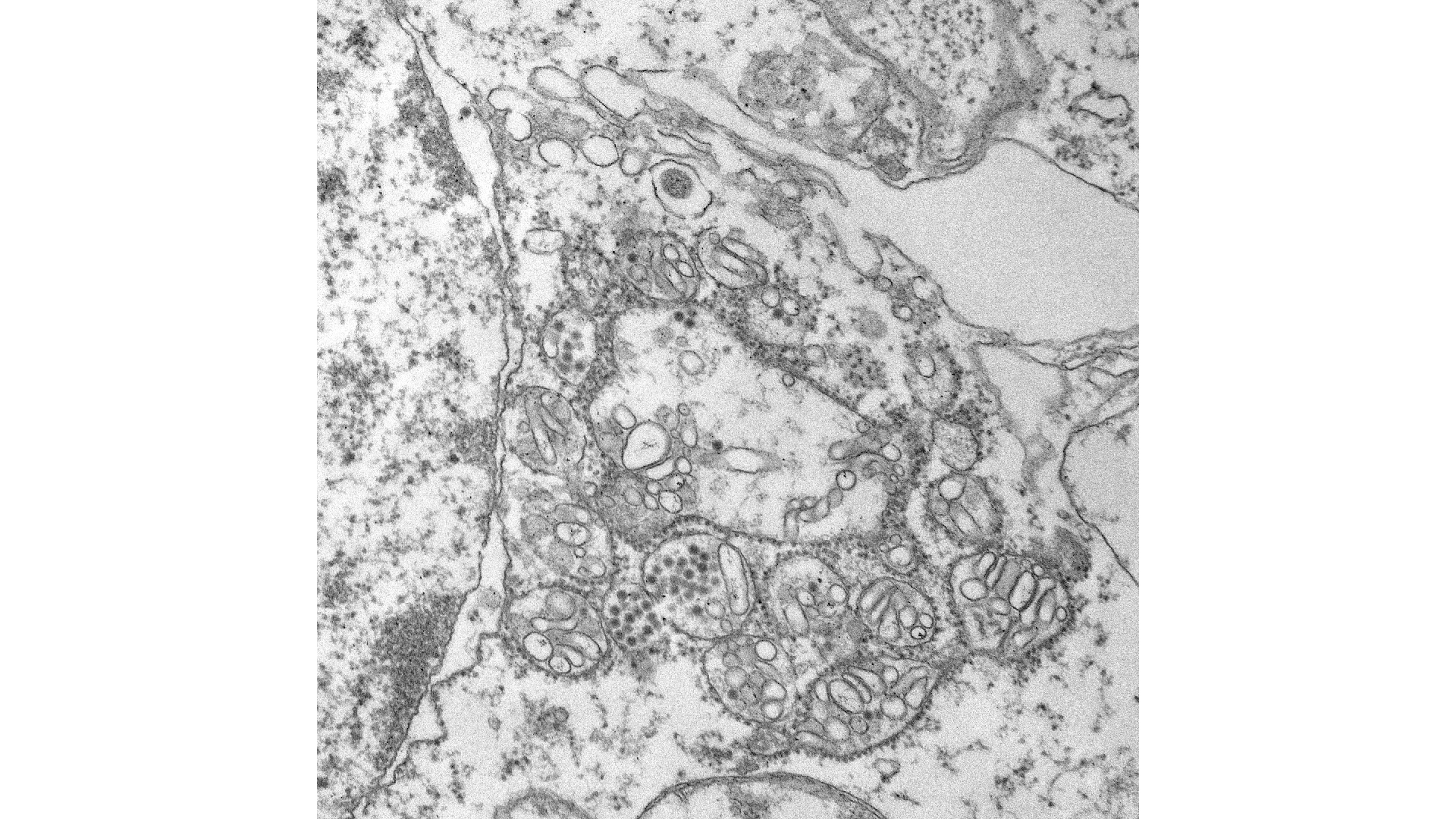This is an electron microscopic image of Zika virus found in the cytoplasm of a neuron in a fetal brain.